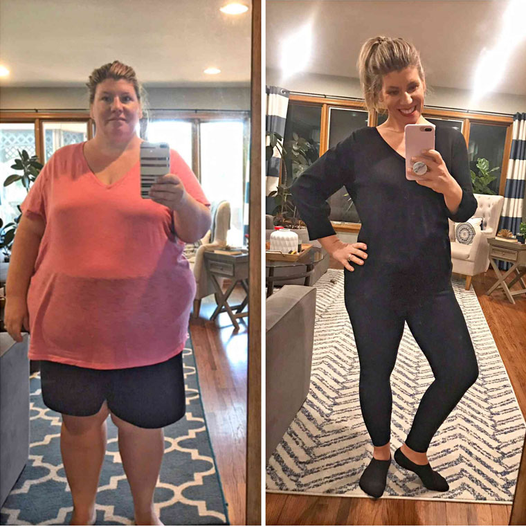 Before and after photos of a patient's weight loss transformation